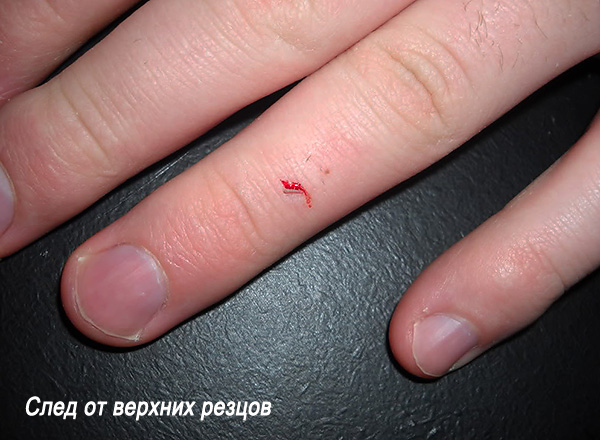 Les conséquences d'une attaque de rat sur l'homme - une plaie des incisives supérieures.