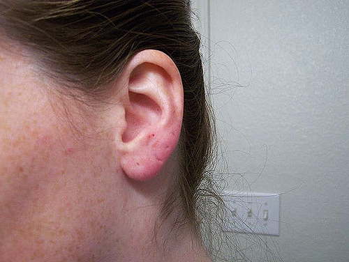 Le rat mordit la femme par l'oreille, laissant des cicatrices caractéristiques.