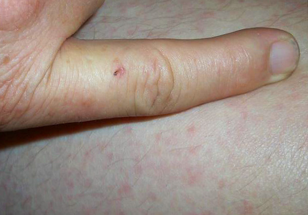 Les symptômes d'une maladie contractée après une morsure de rat peuvent apparaître même après un mois, lorsque la plaie a le temps de guérir.