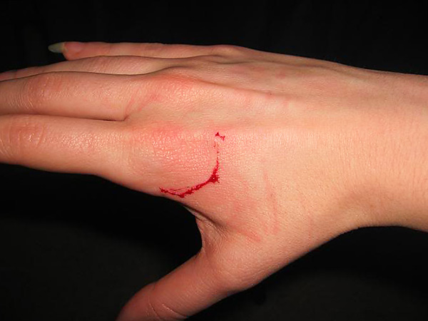 Les piqûres de rongeurs sont caractérisées par la présence de deux points, où la plaie est la plus profonde - ce sont des traces des incisives supérieures et inférieures.