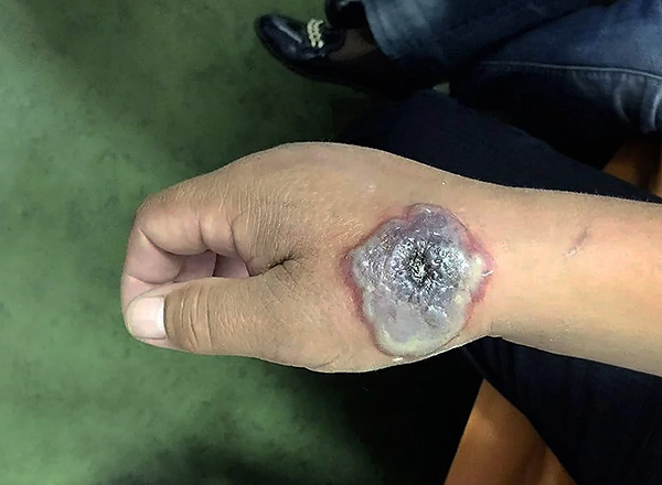 Les morsures de rongeurs non traitées dans les cas avancés peuvent conduire à la suppuration, à l'ulcération, à la gangrène et même à l'amputation du membre.