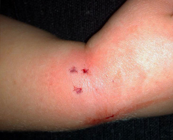 Un rat mord facilement à travers la peau humaine.